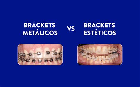 cual es la diferencia entre brackets metalicos y esteticos|Diferencia entre materiales de los brack.